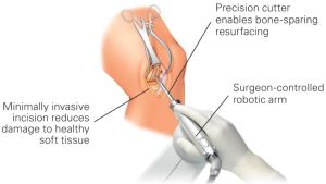 Partial Knee Replacements