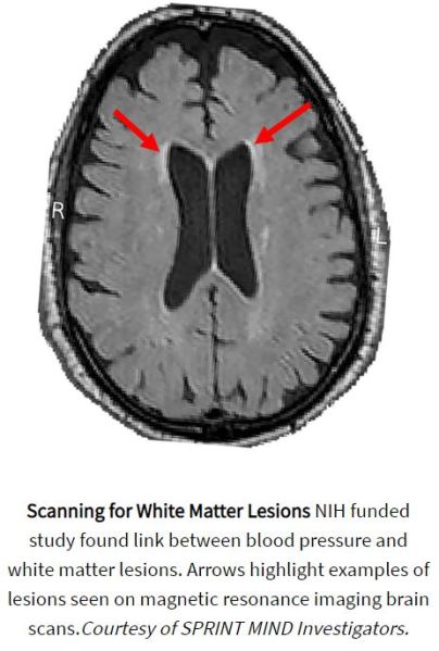 Blood Pressure link to white matter lesions