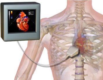 Echocardiogram wikipedia
