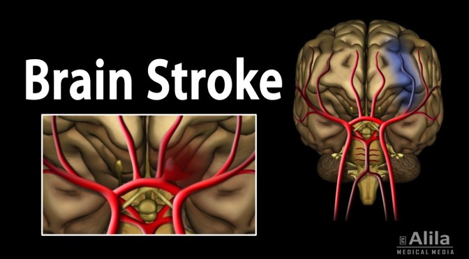 Health: Types Of Stroke – Ischemic & Hemorrhagic