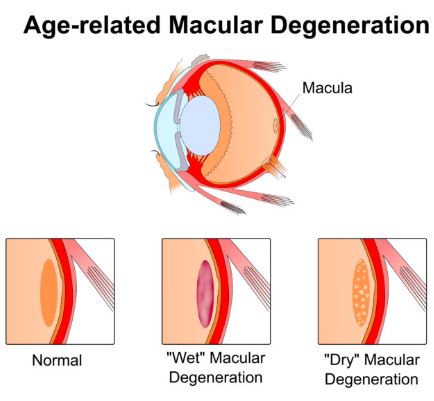 Age-Related Macular Degeneration