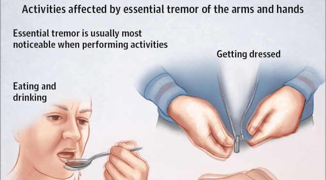 Health: Diagnosing “Essential Tremor” Movement Disorder