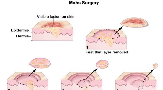 Medical: “Mohs Micrographic Surgery” For Skin Cancer Explained