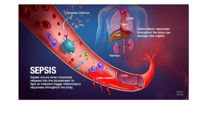Mayo Clinic Health Video: Dangers Of “Sepsis” Now Require Response Teams In Intensive Care Units