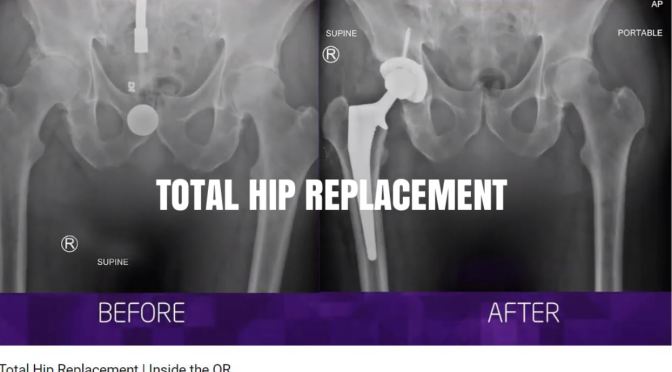Medical Procedures: Inside Look At “Total Hip Replacement” Surgery