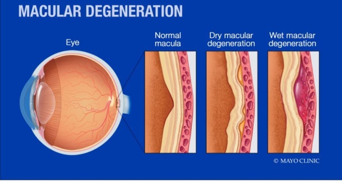 Health Talk: “Macular Degeneration” – Diagnosis & Treatment (Mayo Clinic)