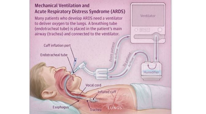 Health: “Mechanical Ventilation And Acute Respiratory Distress Syndrome” (Infographic)