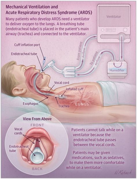 Mechanical Ventilation and Acute Respiratory Distress Syndrome ARDS - Infographic
