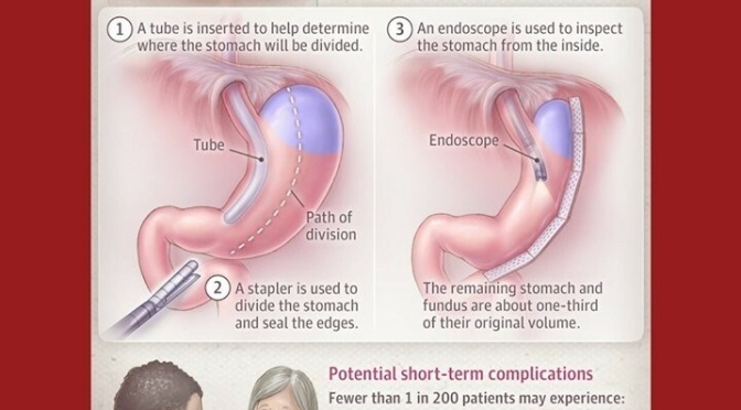 Infographics: “Vertical Sleeve Gastrectomy”