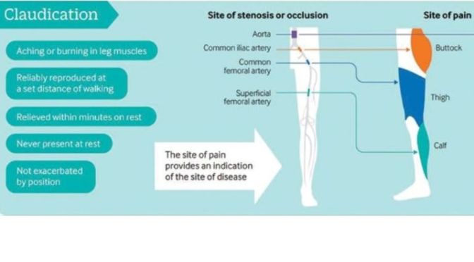 Infographic: Exercise For ‘Claudication’ (BMJ Study)