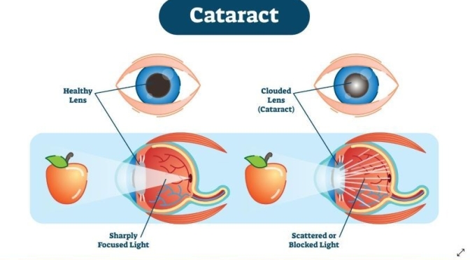 Aging & Healthcare: ‘Cataract Surgery’ (Video)