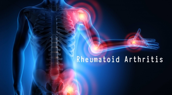 Medicine:  ‘AI’ Can Predict Rheumatoid Arthritis
