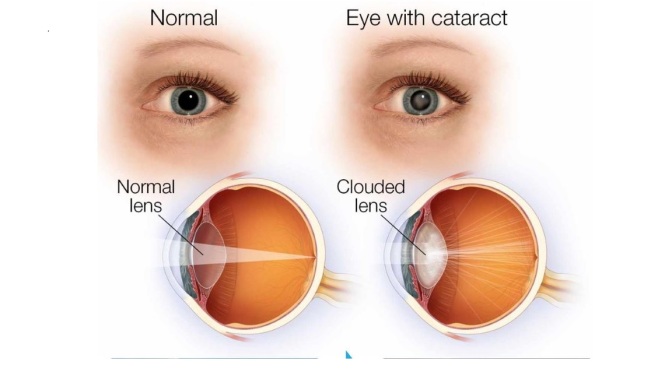 EYE HEALTH: THE SIGNS AND DIAGNOSIS OF CATARACTS