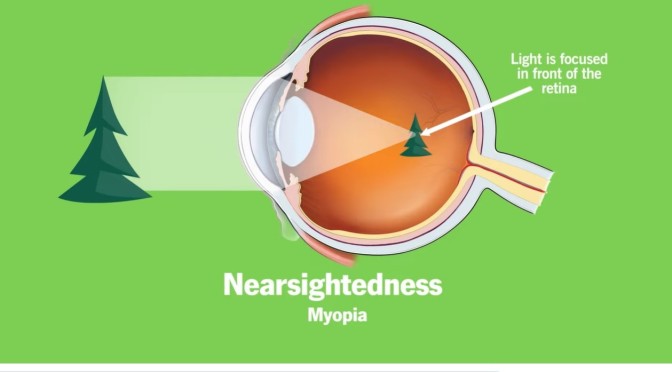 Eye Health: The Causes Of Nearsightedness (Myopia)